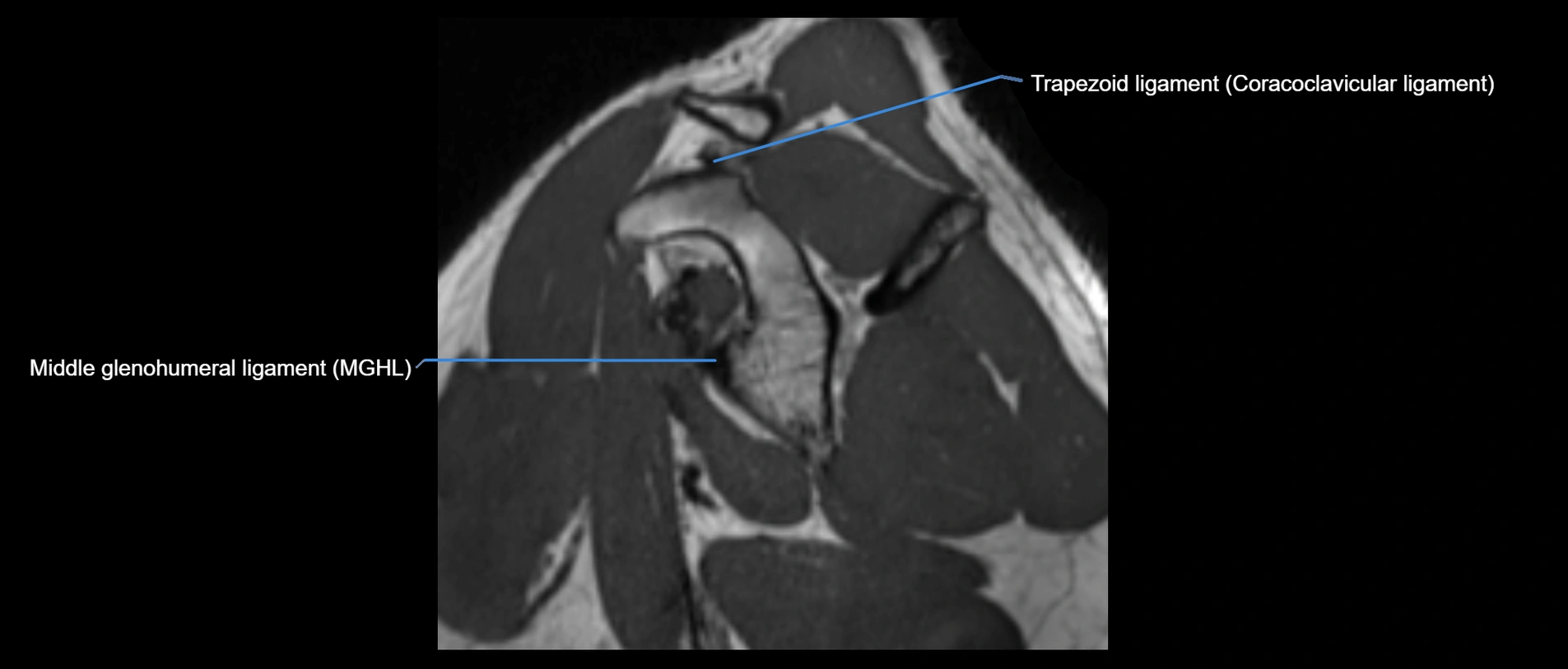 shoulder ligaments sagittal  cross sectional anatomy 3T MRI AI enhanced radiology image -img-00001-00020.webp